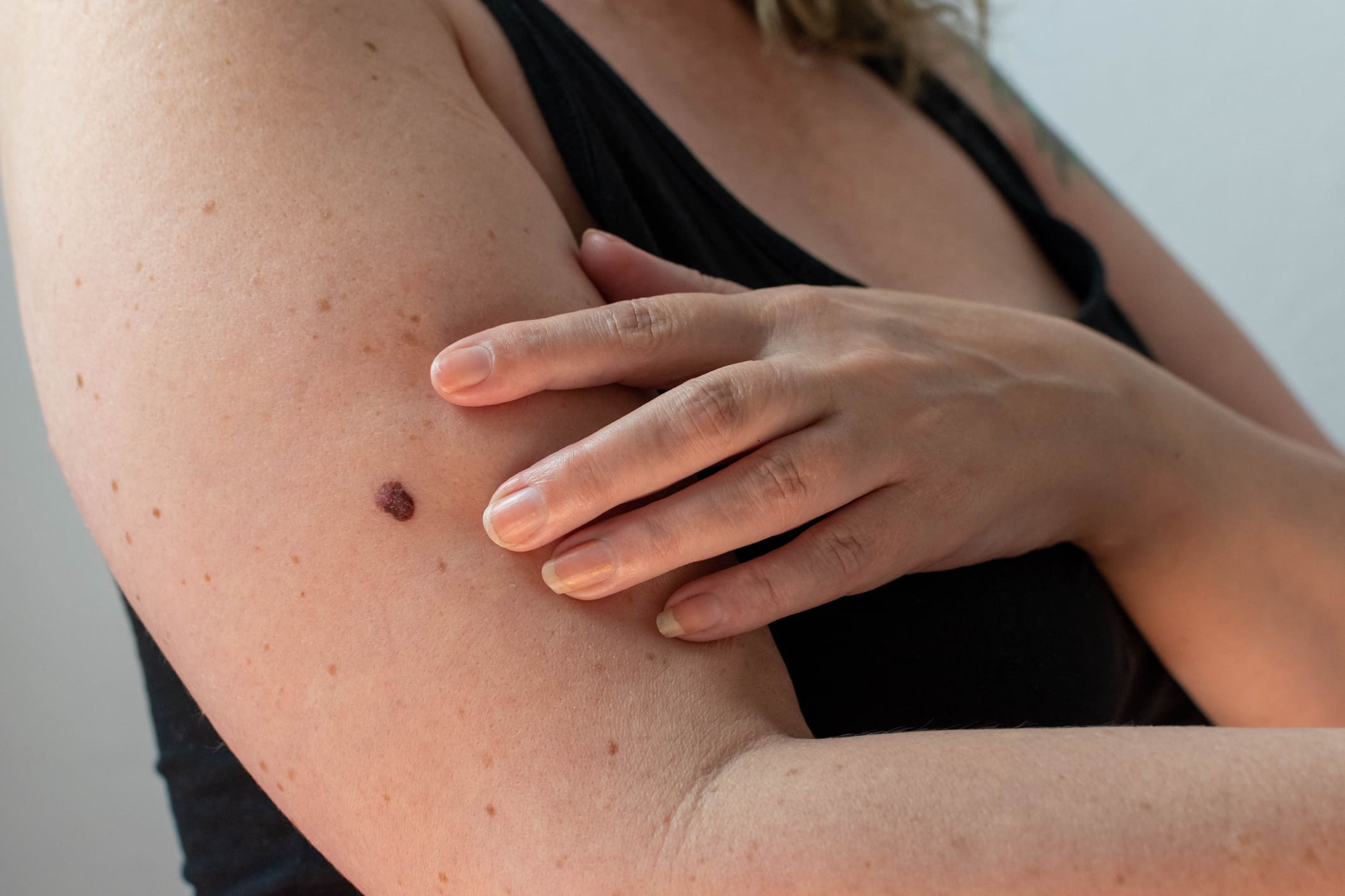 Frau mit großem Muttermal am Arm